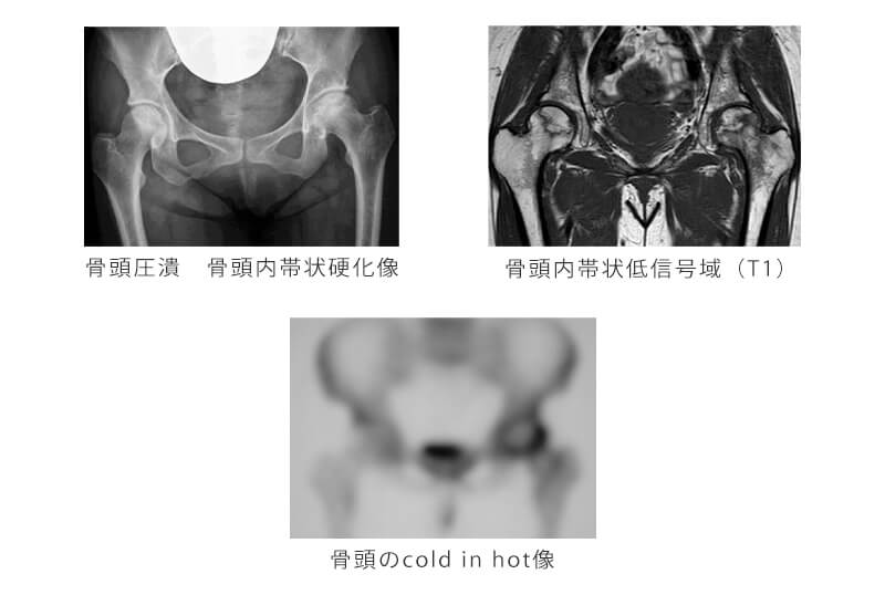 レントゲン写真の所見（図5）MRI、骨シンチグラム（cold　in　hot像）