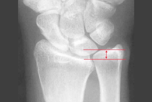 TFCC損傷の病態