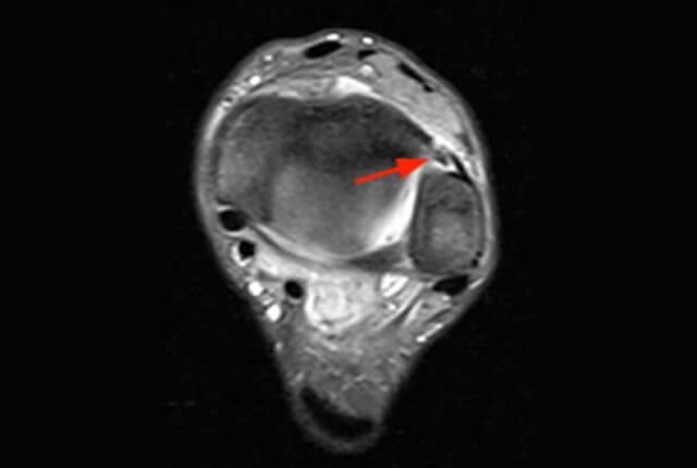 MRI