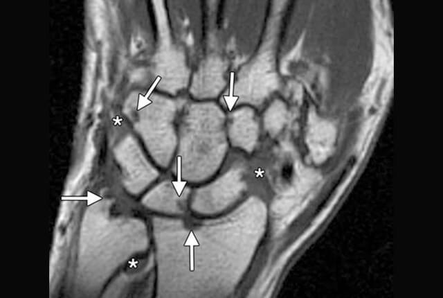 MRI